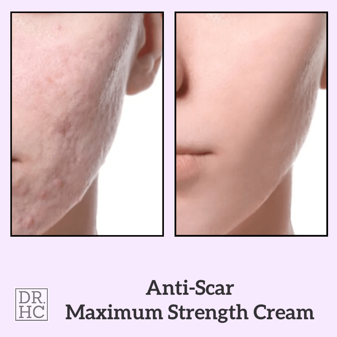 DR.HC Anti-Scar Maximum Strength Cream (10g, 0.35oz.) (Anti-scar, Skin Recovery, Anti-blemish, Anti-inflammatory...)